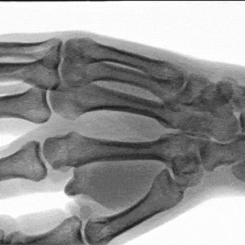 CIS x- ray hand